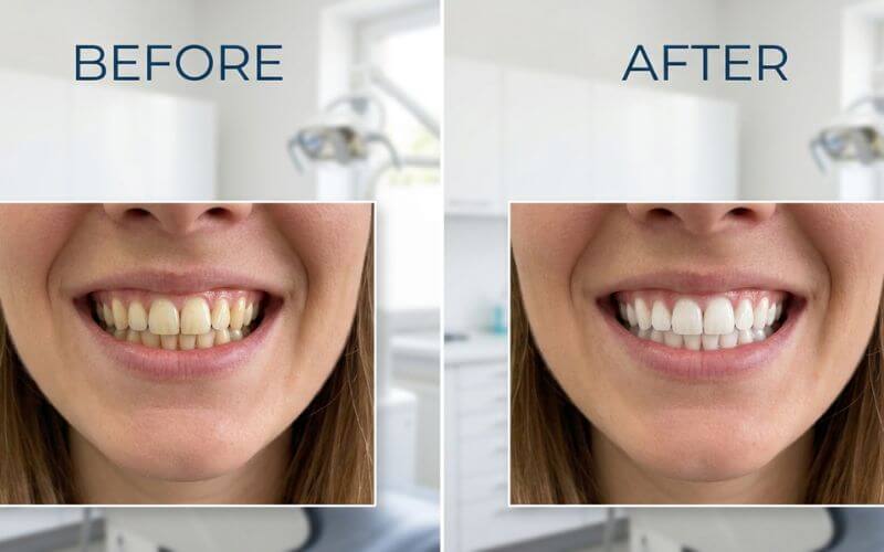 Before and after teeth whitening results showing stain removal and brighter smile using home kits